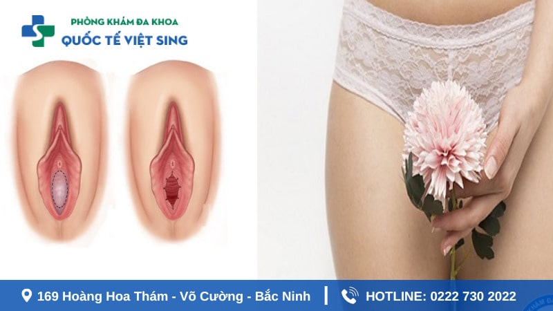 Quy trình vá màng trinh diễn ra như thế nào?