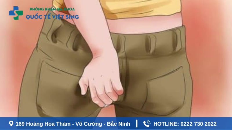Tại sao bị ngứa hậu môn sau cắt trĩ?