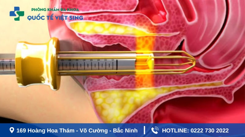 Thu hẹp vùng kín bằng Laser là gì ?