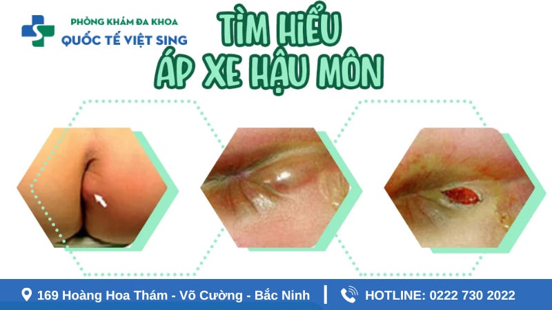 Bệnh áp xe hậu môn là gì?
