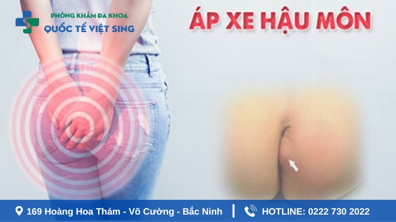Áp xe hậu môn là gì?