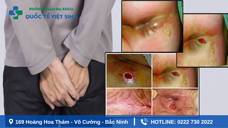 Tổng quan về áp xe hậu môn trực tràng là gì?