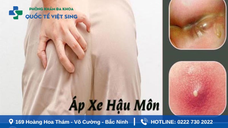 Triệu chứng áp xe hậu môn thường gặp