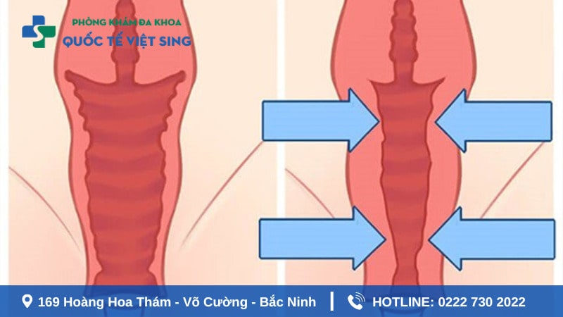 Vì nữ giới nên thu hẹp âm đạo ?