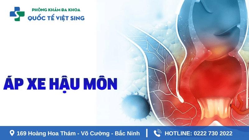 Yếu tố đánh giá địa chỉ y tế khám áp xe hậu môn uy tín?