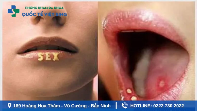 Bệnh lậu có lây qua đường miệng không?