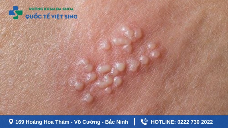 Bệnh lậu tái phát lại do sử dụng sai thuốc