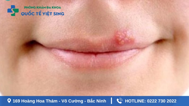 Bệnh lậu lây qua miệng 