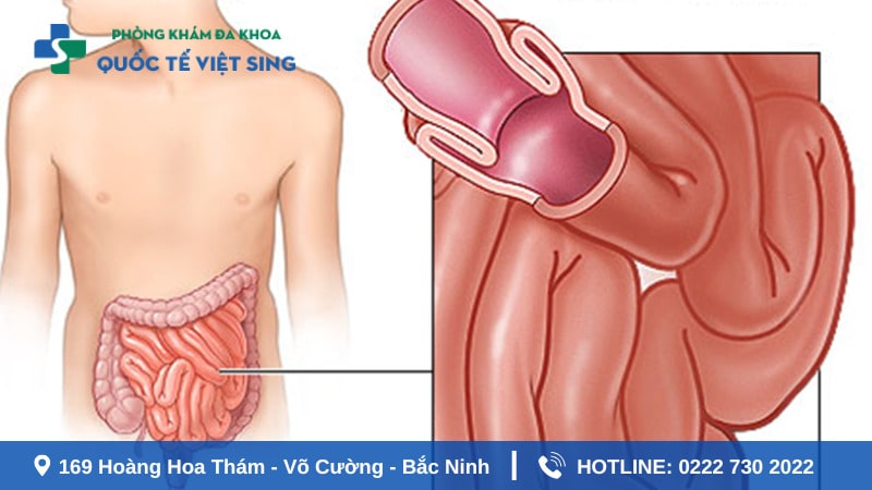 Bệnh lồng ruột cấp tính khiến bé đi ngoài ra máu chất nhày