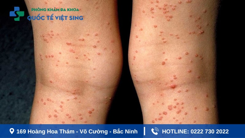 Biến chứng của bệnh lậu có dẫn đến HIV không?
