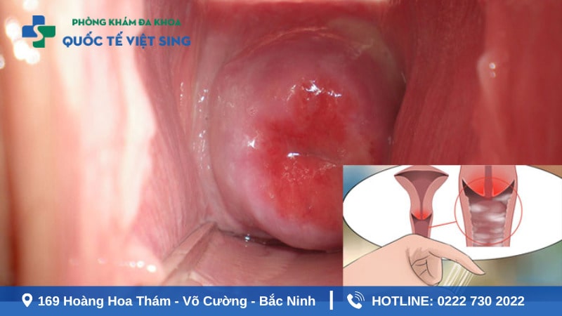 Biểu hiện giai đoạn đầu ở nữ giới
