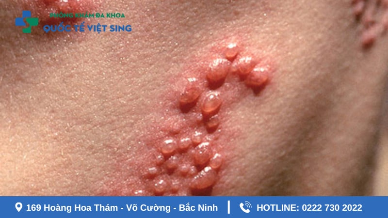 Các biểu hiện thường gặp của bệnh lậu