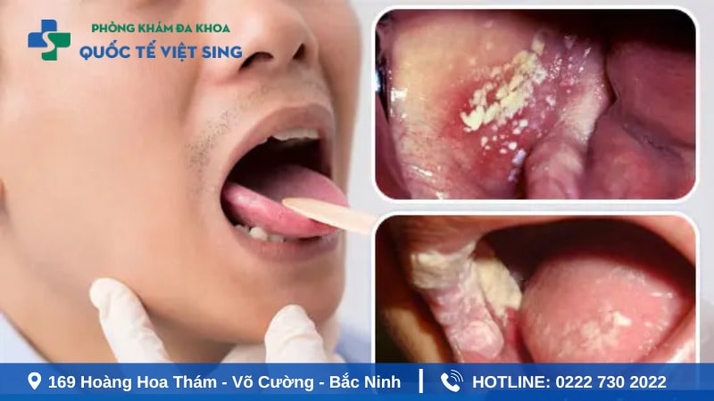 Các dấu hiệu bệnh lậu ở miệng cần chú ý ở nam giới và nữ giới
