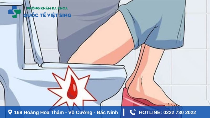 cắt trĩ xong đi ngoài ra máu do bệnh tái phát