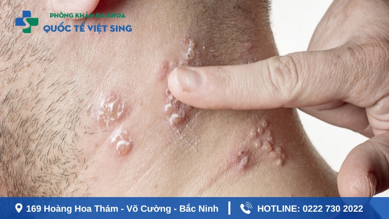 Chẩn đoán và điều trị bệnh lậu bằng cách nào?