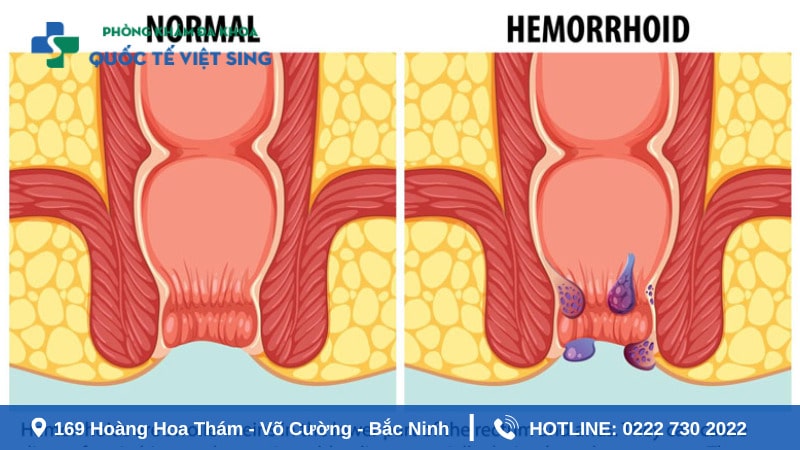 Đại tiện là máu có thể dấu hiệu của bệnh trĩ