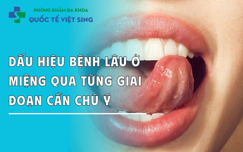 https://dakhoaquoctebacninh.com/wp-content/uploads/2025/06/dau-hieu-benh-lau-o-mieng-bieu-hien-qua-cac-trieu-chung-can-chu-y.jpg