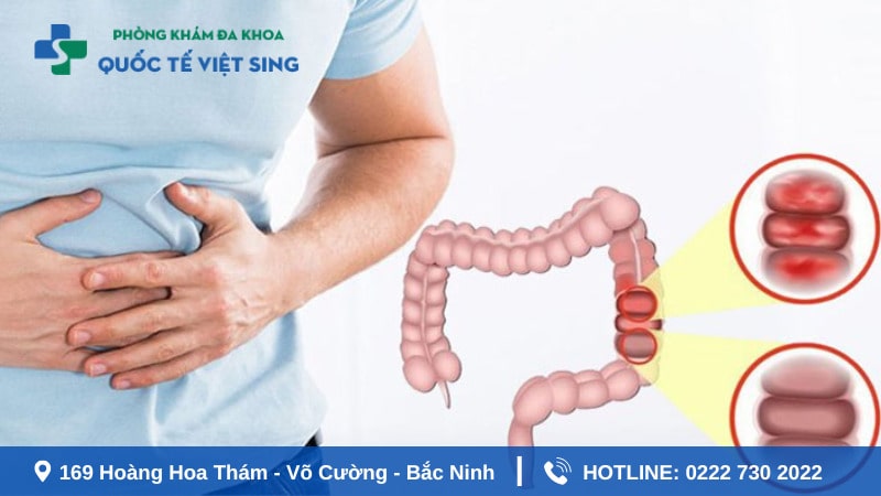táo bọn đi ngoài ra máu do viêm túi thừa