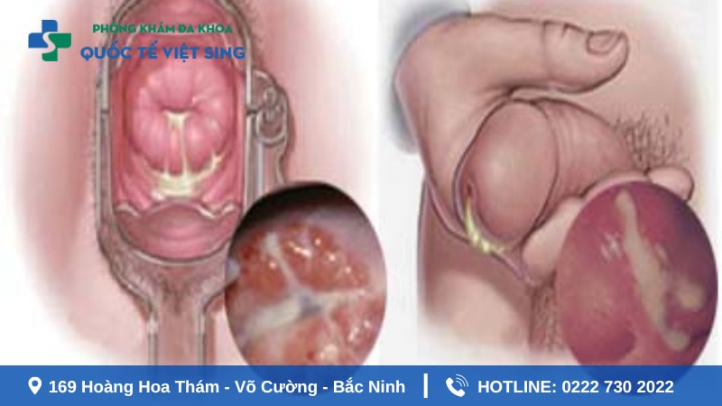 Dấu hiệu nhận biết bệnh lậu ở nam và nữ cần chú ý