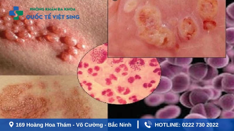 Dấu hiệu nhận biết mắc bệnh lậu là gì?