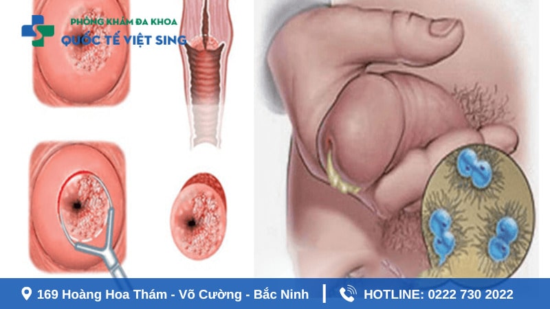 Tiết dịch bất thường ở bộ phận sinh dục dấu hiệu bệnh lậu