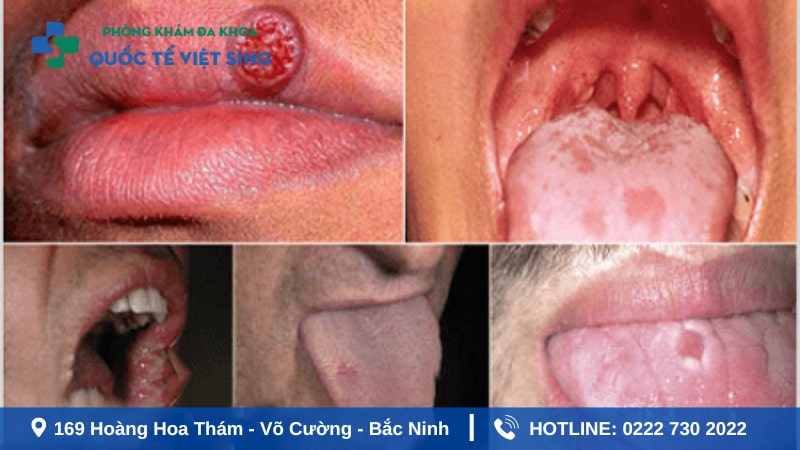 Dấu hiệu triệu chứng bệnh lậu phát triển qua từng giai đoạn