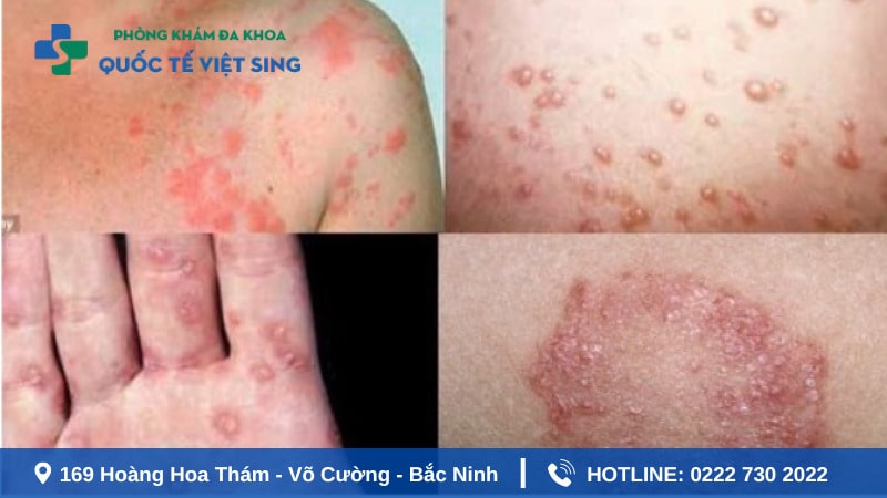 Bệnh lậu là bệnh gì ?