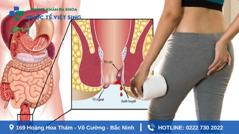 Triệu chứng ngứa hậu môn do nhiễm giun kim