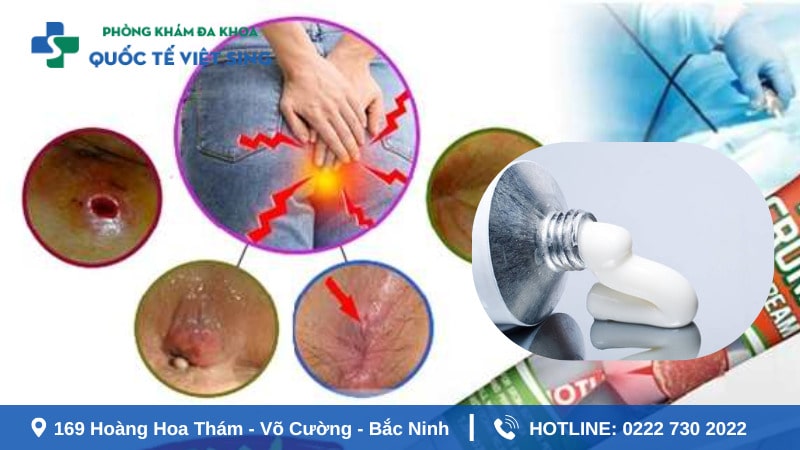 Bị ngứa hậu môn nên bôi thuốc gì hiệu quả ?