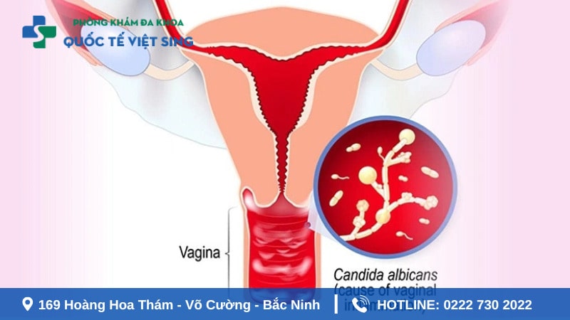 Ngứa hậu môn và vùng kín là tình trạng gì?