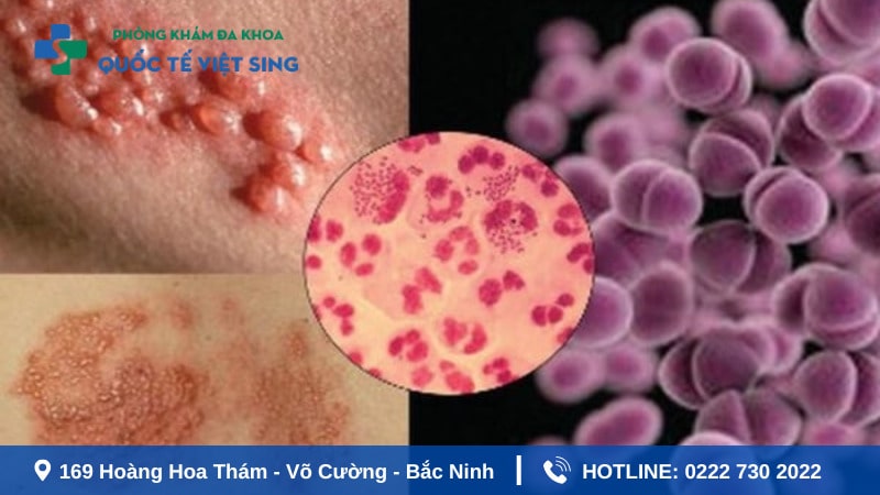 Nguyên nhân gây bệnh lậu là gì? Lây qua đường nào