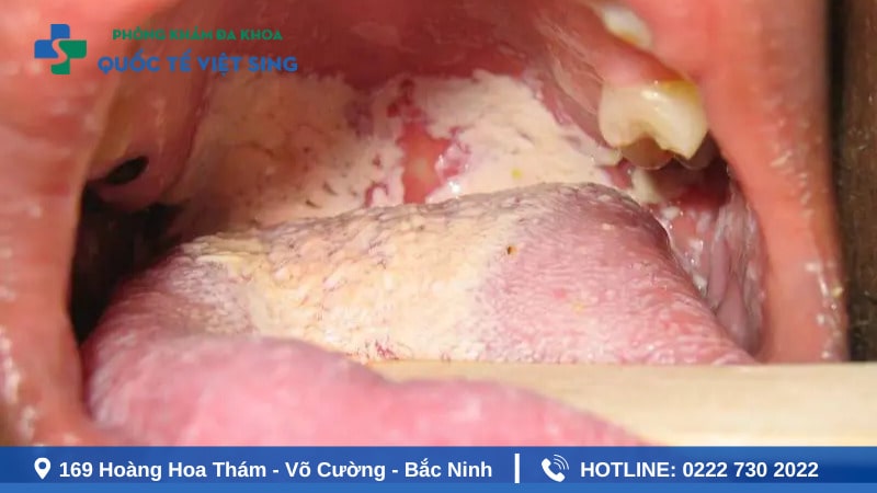 Nguyên nhân gây ra bệnh lậu ở họng