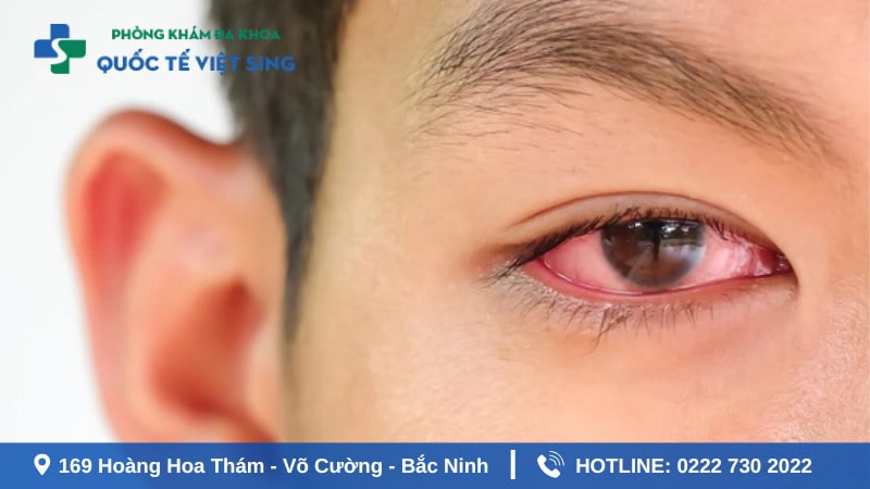 Nguyên nhân nào gây ra bệnh lậu ở mắt?