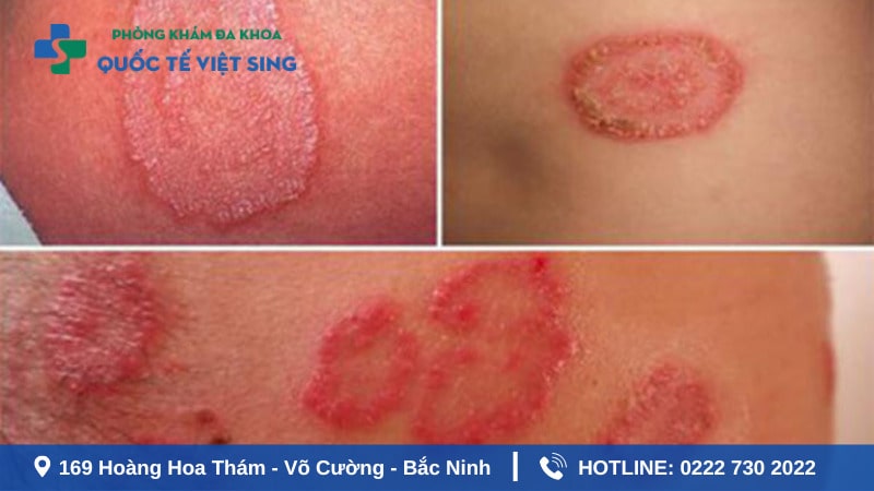 Nguyên nhân lây nhiễm của bệnh lậu