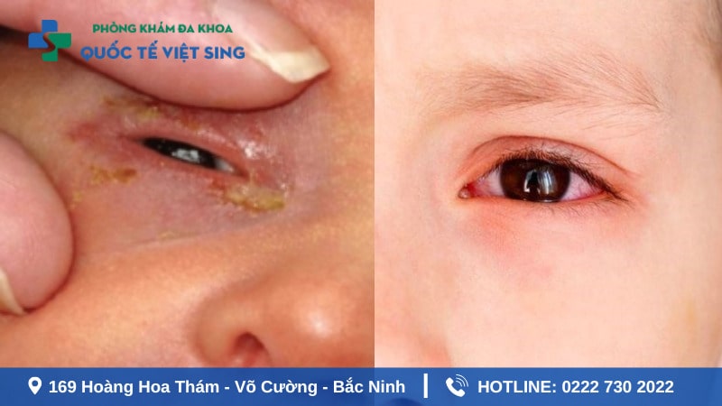 Nhận biết đúng dấu hiệu bệnh lậu ở mắt cần chú ý