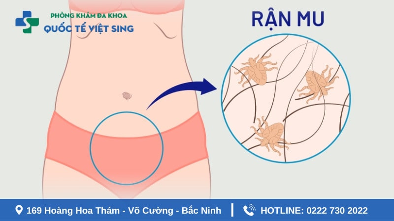 Nhiễm rận lông mu gây ngữa hậu môn và vùng kín