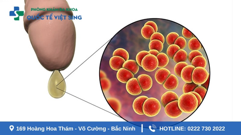 Những dấu hiệu bệnh lậu tái phát lại bạn cần lưu ý