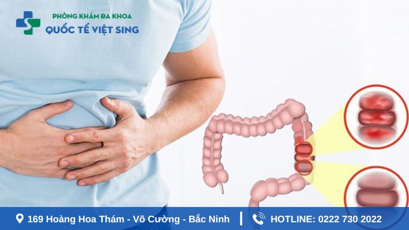 Hiện tượng nóng trong đi ngoài ra máu có nguy hiểm không?
