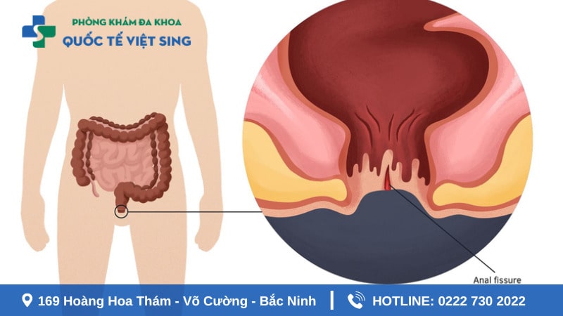 Do điều trị bệnh chưa triệt để