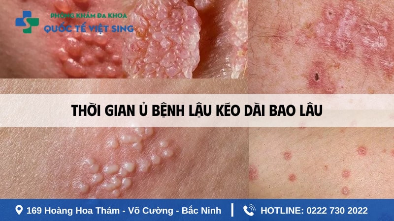 Thời gian ủ bệnh lậu kéo dài bao lâu?