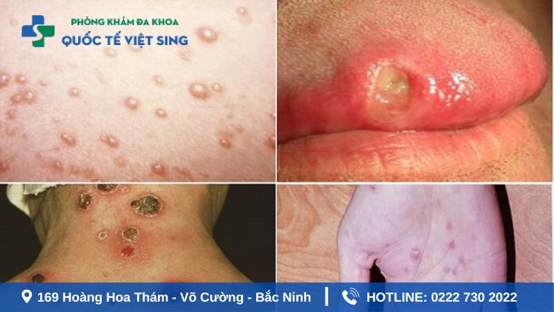 Thông tin về bệnh lậu cầu