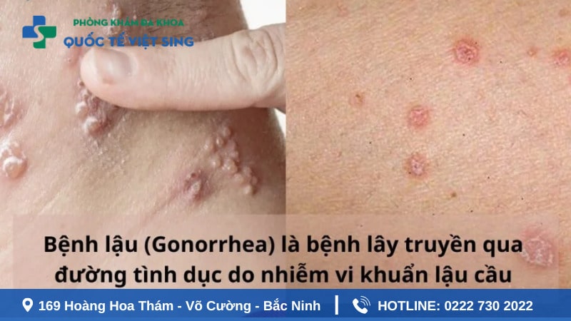 Tìm hiểu bệnh lậu là gì?