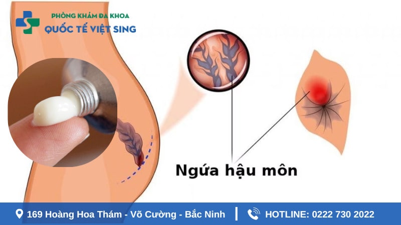 Tìm hiểu về tính trạng ngứa hậu môn là gì?