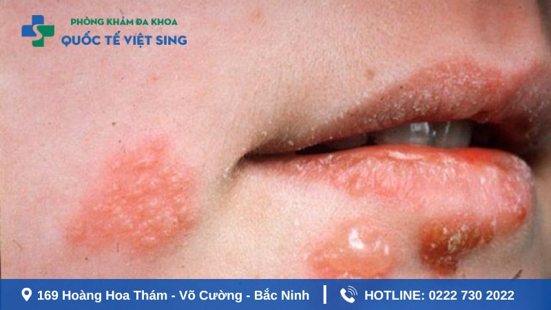 Tổng quan về bệnh lậu cần chú ý