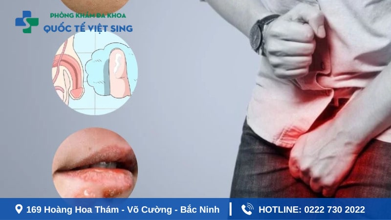 Triệu chứng của bệnh lậu điển hình ở nam giới