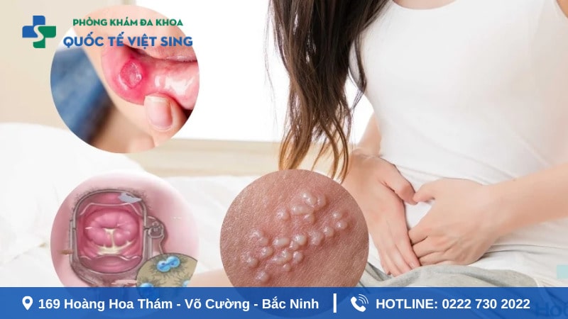 Triệu chứng của bệnh lậu điển hình ở nữ giới