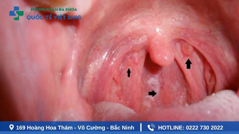 Triệu chứng lậu ở họng giai đoạn cấp tính