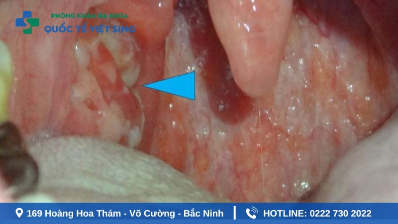 Triệu chứng lậu ở họng giai đoạn mãn tính