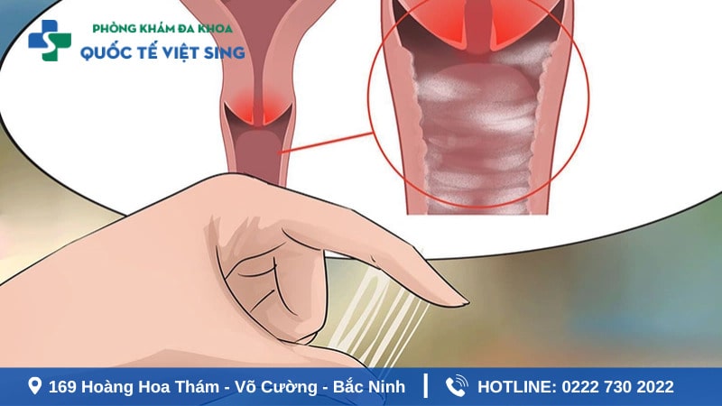 Triệu chứng phát bệnh lậu giai đoạn đầu cần chú ý?