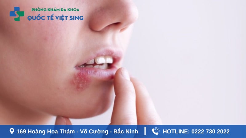 Triệu chứng xuất hiện lậu ở miệng cần chú ý